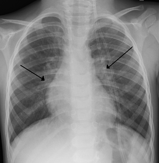 Bronchiolitis Blockage of the small airways in the lungs due to a viral infection