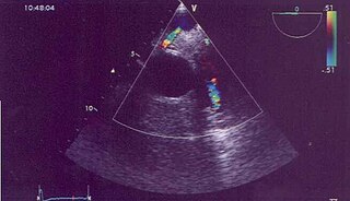 <span class="mw-page-title-main">Anomalous left coronary artery from the pulmonary artery</span> Medical condition