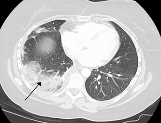 <span class="mw-page-title-main">Bronchial circulation</span> Circulation of blood supplying lungs tissues