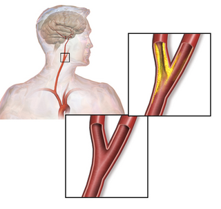 <span class="mw-page-title-main">Carotid artery stenosis</span> Medical condition