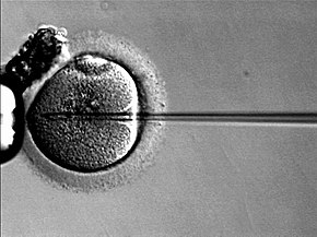 Intracytoplasmic sperm injection can be used to provide fertility for men with cystic fibrosis. Icsi.JPG