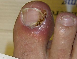 <span class="mw-page-title-main">Nail disease</span> Medical condition