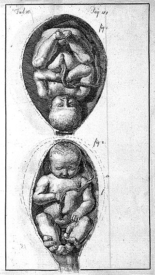 <span class="mw-page-title-main">External cephalic version</span> Process by which a breech baby can sometimes be turned from buttocks or foot first to head first