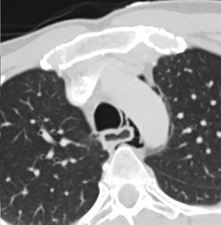 Esophageal rupture Medical condition