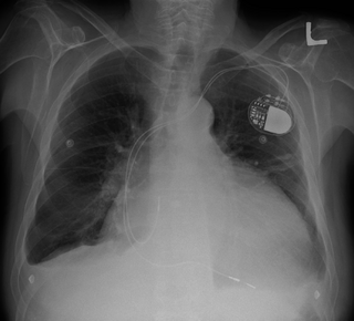 <span class="mw-page-title-main">Cardiomegaly</span> Medical condition