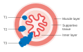 T1, T2, and T3 stages of esophageal cancer