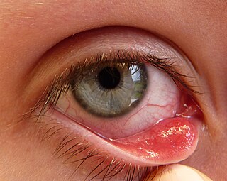 <span class="mw-page-title-main">Chalazion</span> Medical condition