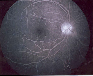 <span class="mw-page-title-main">Fluorescein angiography</span> Technique for examining the circulation of the retina and choroid of the eye