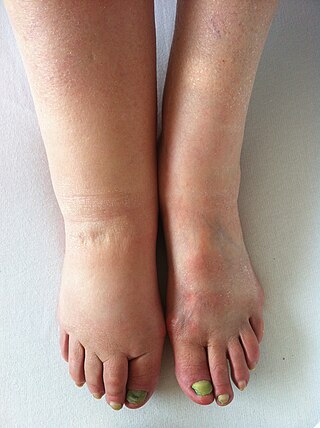 <span class="mw-page-title-main">Lymphedema</span> Medical condition