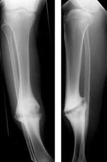 Nonunion Failure of a bone to heal after breakage