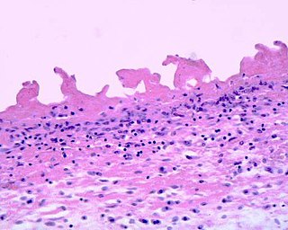 <span class="mw-page-title-main">Uremic pericarditis</span> Medical condition