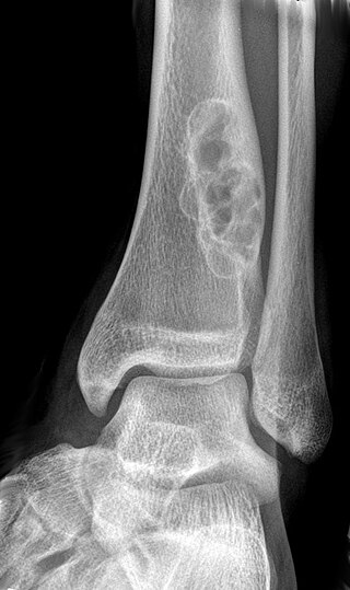 <span class="mw-page-title-main">Non-ossifying fibroma</span> Medical condition