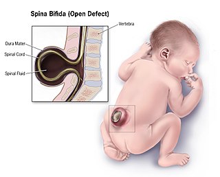 <span class="mw-page-title-main">Spina bifida</span> Birth defect of the spinal cord