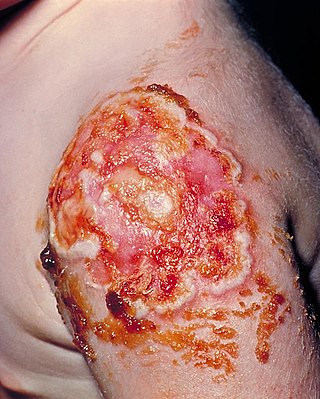 <span class="mw-page-title-main">Progressive vaccinia</span> Medical condition