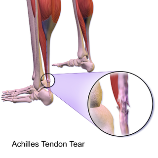 <span class="mw-page-title-main">Achilles tendon rupture</span> Medical condition where the tendon at the back of the ankle breaks