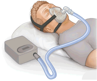 <span class="mw-page-title-main">Positive airway pressure</span> Mechanical ventilation in which airway pressure is always above atmospheric pressure