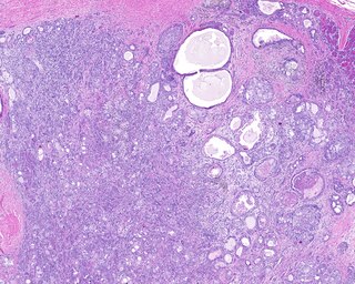 <span class="mw-page-title-main">Sclerosing polycystic adenosis</span> Type of salivary gland tumor