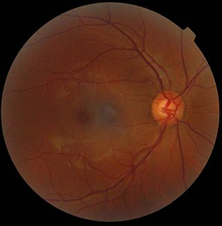 <span class="mw-page-title-main">Optic disc</span> Optic nerve head, the point of exit for ganglion cell axons leaving the eye