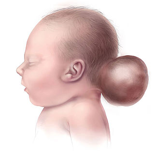 Encephalocele Neural tube defect in which the brain protrudes out of the skull