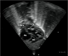 July 30: Transposition of the great vessels, a heart defect.