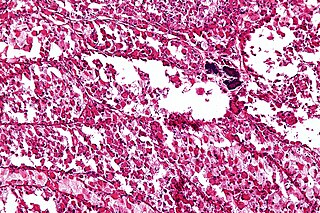 <span class="mw-page-title-main">Alveolar soft part sarcoma</span> Medical condition