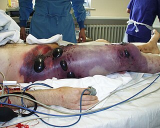 <span class="mw-page-title-main">Gas gangrene</span> Human bacterial infection