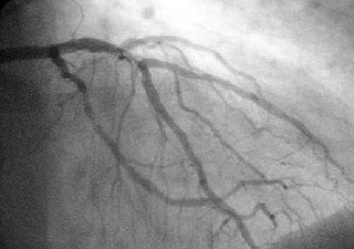 <span class="mw-page-title-main">Percutaneous coronary intervention</span> Medical techniques used to manage coronary occlusion