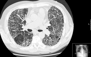 <span class="mw-page-title-main">High-resolution computed tomography</span> Diagnostic imaging test