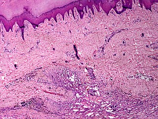 Angiomatosis Medical condition