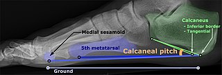 <span class="mw-page-title-main">Calcaneal pitch</span>