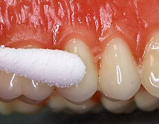 Pulp sensibility test using ethyl chloride (cold stimulus)