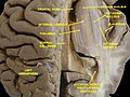 Ventricles of brain and basal ganglia. Close-up of preceding image