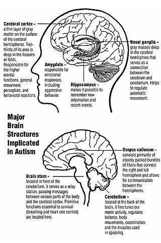 <span class="mw-page-title-main">Classic autism</span> Neurodevelopmental condition