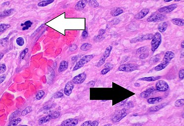 Histopathology of glioblastoma, showing high grade astrocytoma features of marked nuclear pleomorphism, multiple mitoses (one at white arrow) and multinucleated cells (one at black arrow), with cells having a patternless arrangement in a pink fibrillary background on H&E stain.