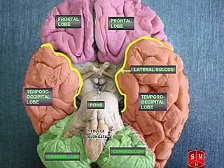 <span class="mw-page-title-main">Associative visual agnosia</span> Medical condition