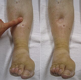 <span class="mw-page-title-main">Edema</span> Accumulation of excess fluid in tissue