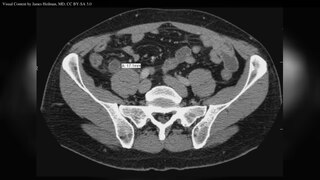 <span class="mw-page-title-main">Appendicitis</span> Inflammation of the appendix