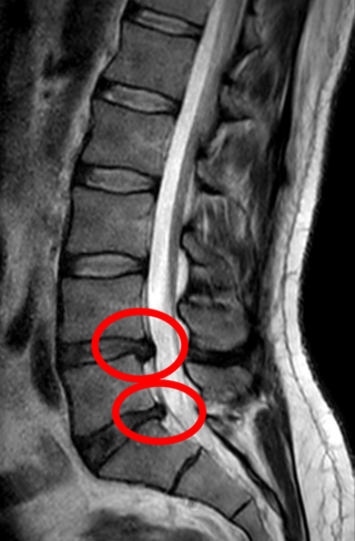 <span class="mw-page-title-main">Spinal disc herniation</span> Injury to the connective tissue between spinal vertebrae