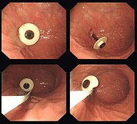 Endoscopic removal of PEG tube PEG removal.jpg