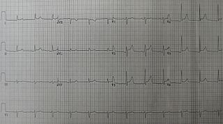 Acute pericarditis Medical condition