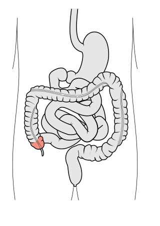 <span class="mw-page-title-main">Cecum</span> Pouch in the large intestine