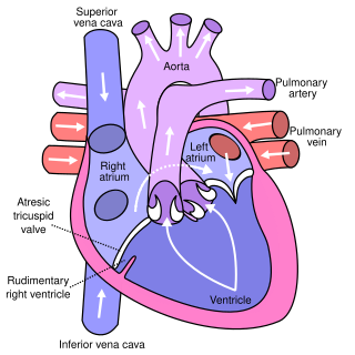 <span class="mw-page-title-main">Tricuspid atresia</span> Medical condition