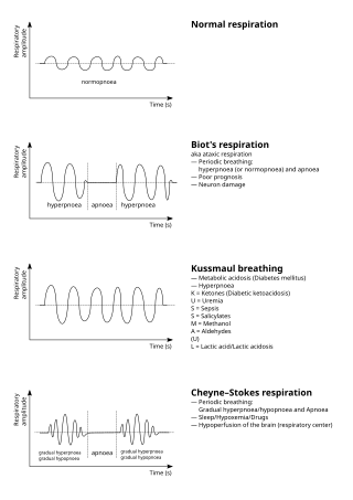 <span class="mw-page-title-main">Cheyne–Stokes respiration</span> Abnormal breathing pattern