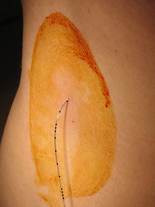 <span class="mw-page-title-main">Epidural administration</span> Medication injected into the epidural space of the spine