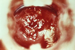 <span class="mw-page-title-main">Cervicitis</span> Inflammation of the uterine cervix