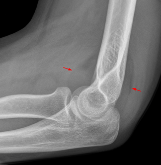 <span class="mw-page-title-main">Fat pad sign</span> Elbow radiography finding indicating a fracture