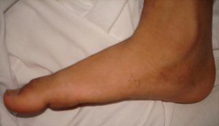 <span class="mw-page-title-main">Flat feet</span> Foot arch deformity