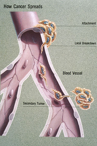 <span class="mw-page-title-main">Metastasis</span> Spread of a disease inside a body