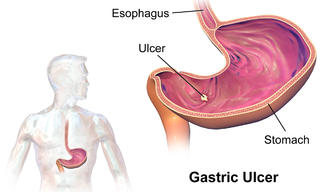 <span class="mw-page-title-main">Ulcer</span> Inflamed break in bodily tissue that impedes function of the affected organ