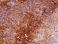 Immunohistochemistry for S100 in a schwannoma (WHO grade 1)